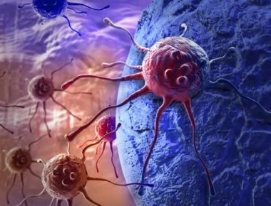 Καρκίνος του παχέος εντέρου – Συμπτώματα: 1 στους 4 τα μπερδεύει με αυτό!